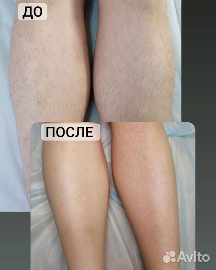 Шугаринг депиляция