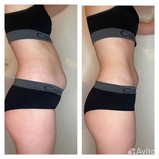 Антицеллюлитный массаж, классический массаж