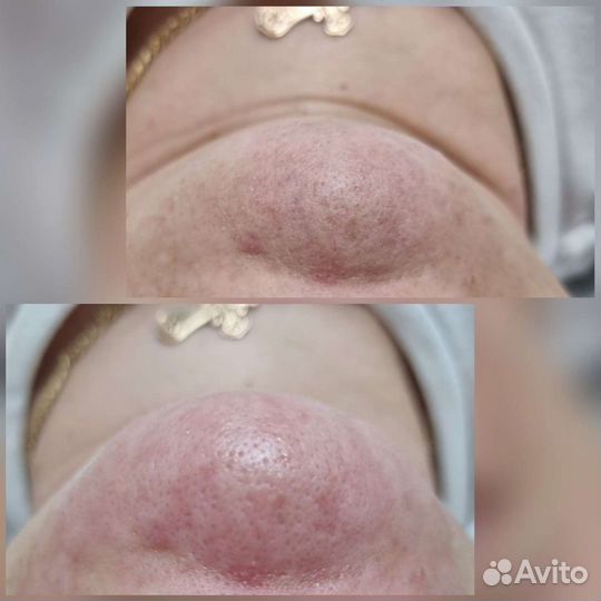 Чистка лица,Люберцы