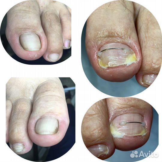 Вросший ноготь Подолог Педикюр
