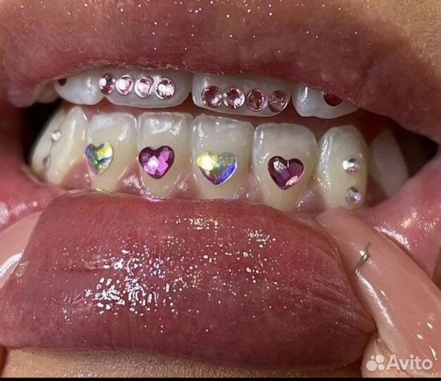 Скайсы Установка кристаллов на зубы