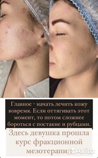 Косметолог чистка лица лечение акне