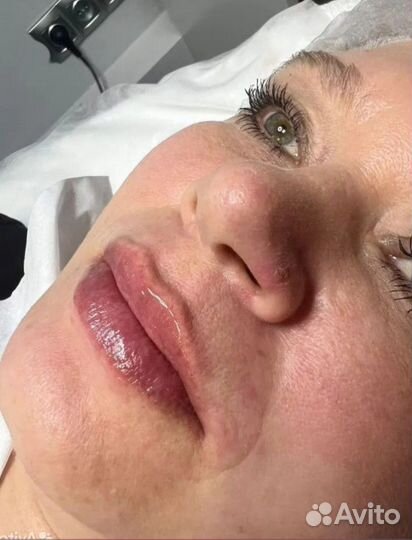 Увеличение губ. Плоский бант