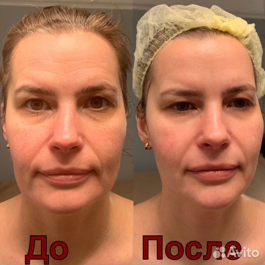 Массаж, массаж лица, RF, кавитация, лазерный липол