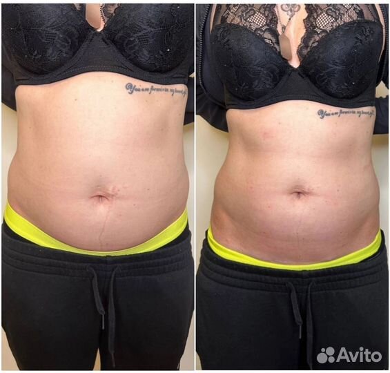 RET кавитация