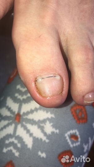 Наращивание ногтей Акрилом, Полигель