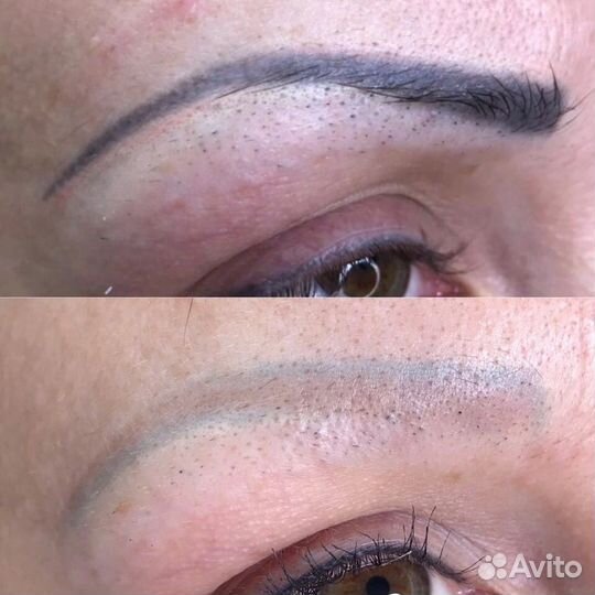 Лазерное удаление тату