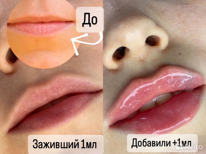 Увеличение губ без боли
