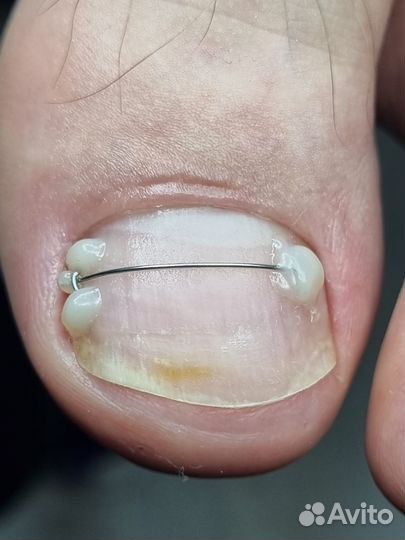 Титановая нить, Вросший ноготь. Подолог