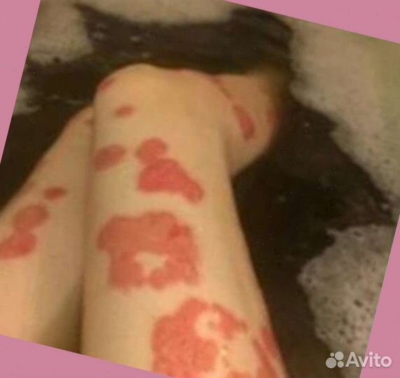 Мазь от псориаза