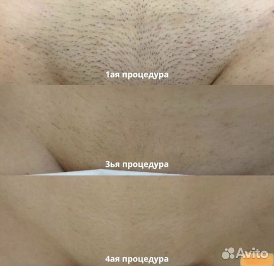Лазерная эпиляция