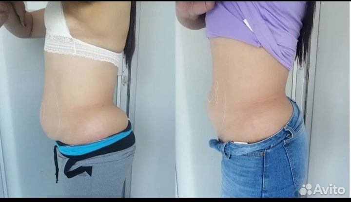 Криолиполиз