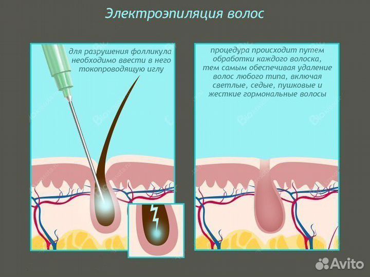 Электроэпиляция