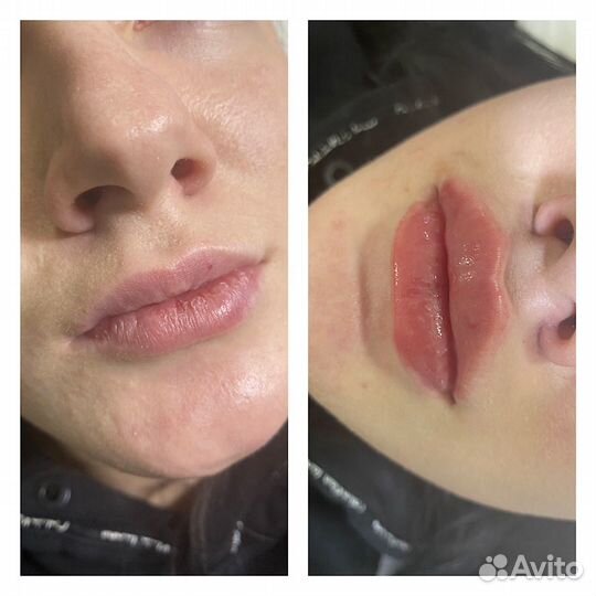 Увеличение губ