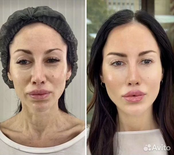 Подтяжка лица за 1 процедуру. СМАС лифтинг