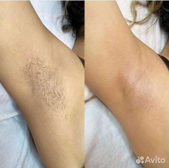 Лазерная эпиляция