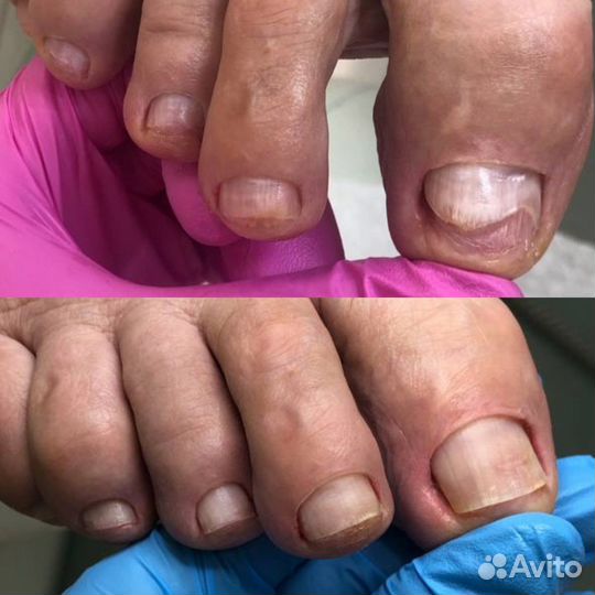 Подолог, вросший ноготь, мозоли