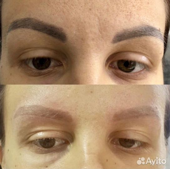 Удаление татуаж,тату и пигментных пятен