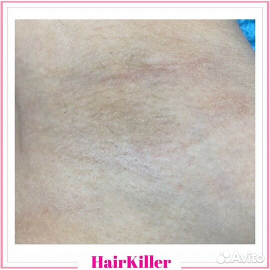 Лазерная эпиляция. Диодный лазер. Медобразование