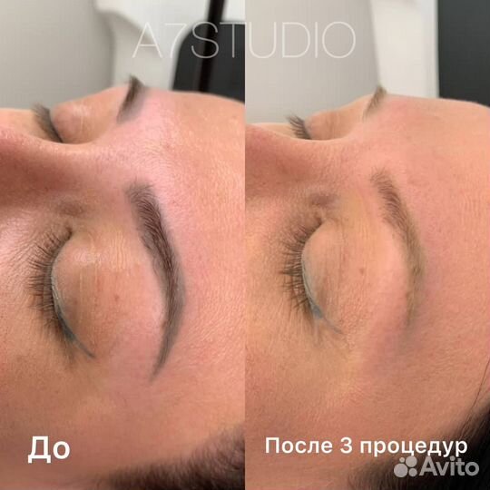 Лазерное удаление татуажа Удалить татуаж