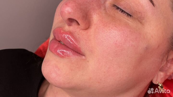 Модель на увеличение губ