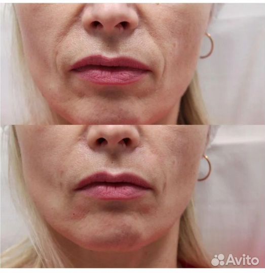 Услуги косметолога уколы красоты