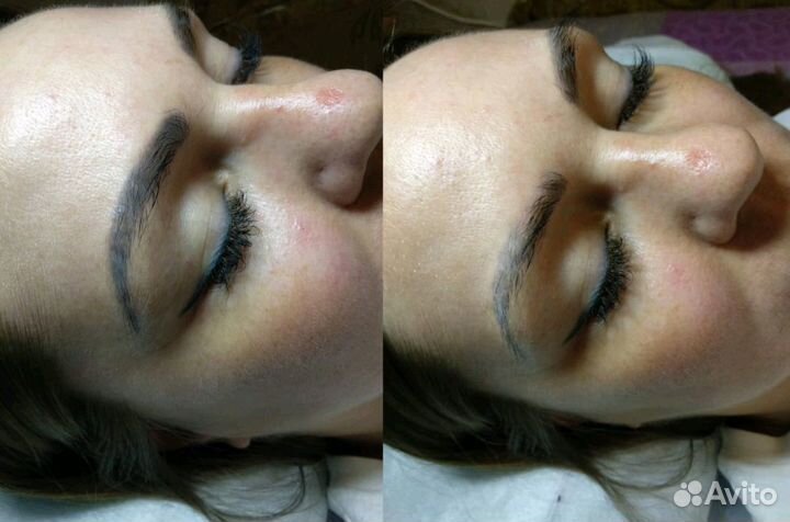 Татуаж, исправление, удаление, комуфляж шрамов