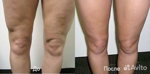 Вакуумно - роликовый массаж