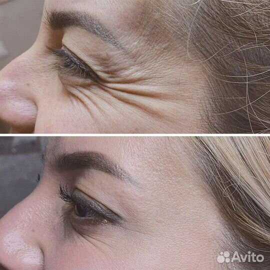 Ботокс для лица / Ботулинотерапия / Диспорт