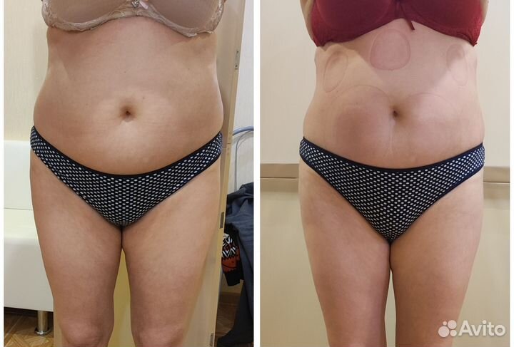 Аппаратная коррекция фигуры