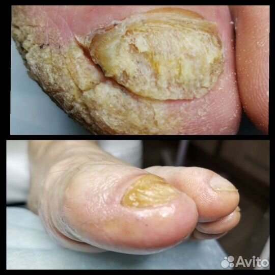 Медицинский педикюр,подолог, вросшие ногти