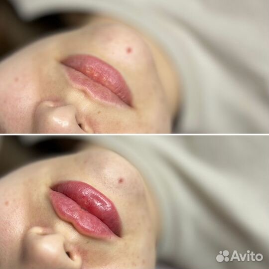 Увеличение губ