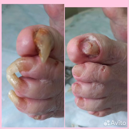 Медицинский педикюр (подолог)