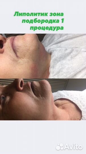 Липолитики лицо тело