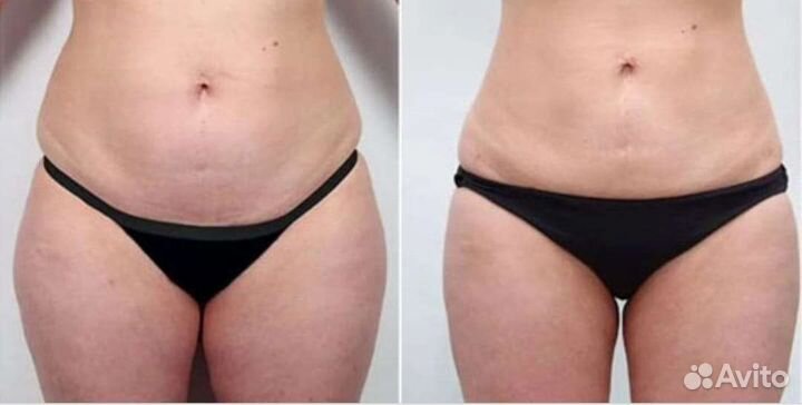 Коррекция фигуры криолиполиз,LPG массаж