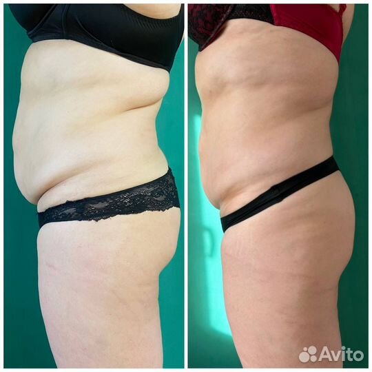 Аппаратный массаж, похудение, коррекция фигуры