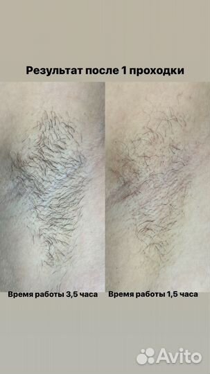 Электроэпиляция