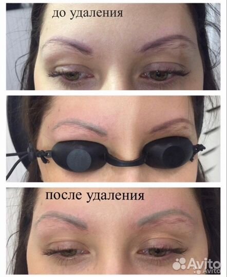 Удаление татуаж,тату и пигментных пятен