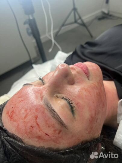 Аппаратная мезотерапия