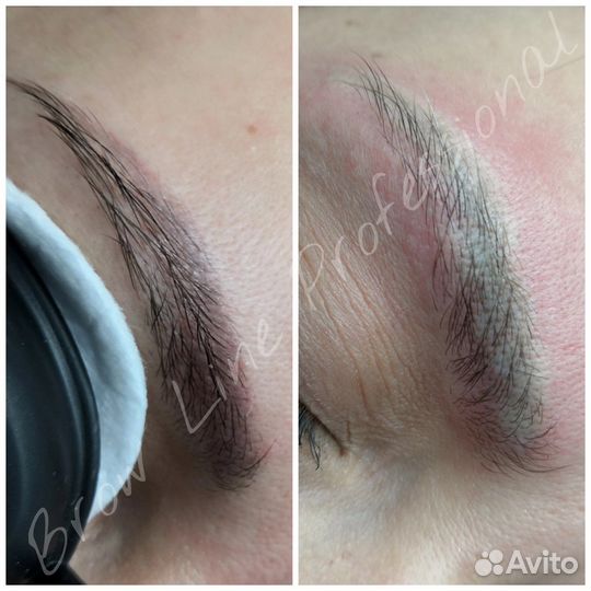 Удаление татуажа, тату