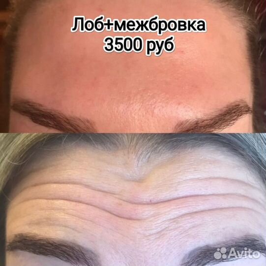 Ботулинотерапия