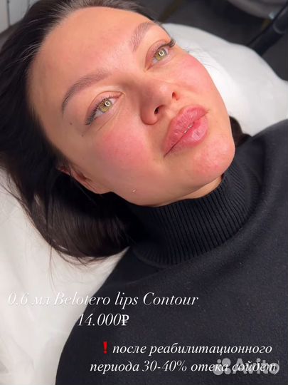 Контурная пластика губ