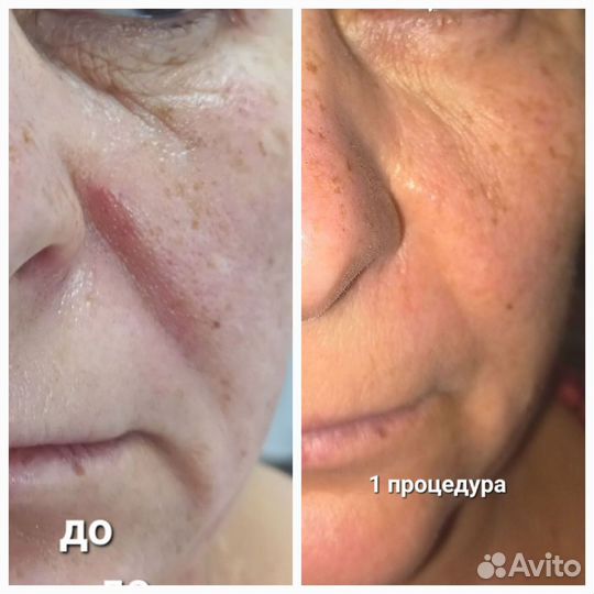 Омоложение лица