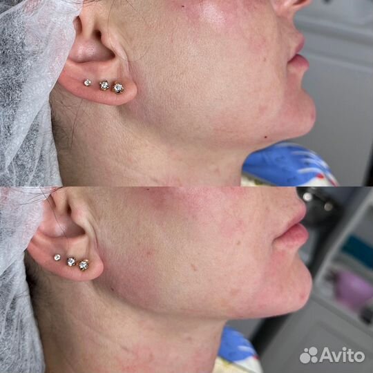 Косметолог, увеличение губ, ботокс