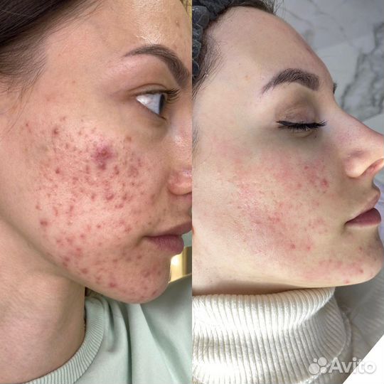 Обучение акне / постакне / коррекция рубцов