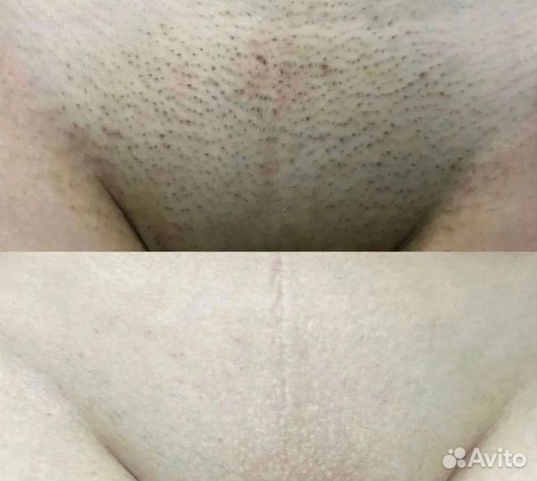 Лазерная эпиляция