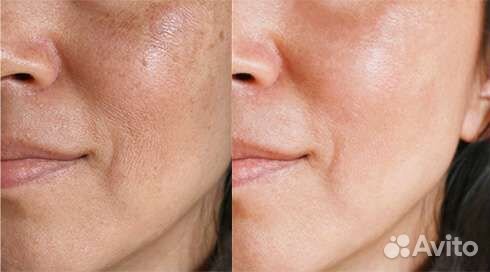 Дарсонвализация