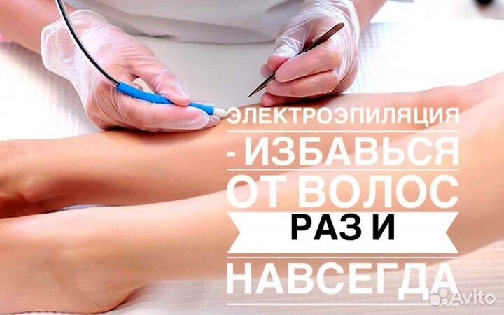 Электроэпиляция