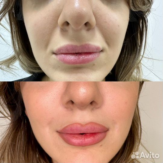 Носогубные складки требуются модели