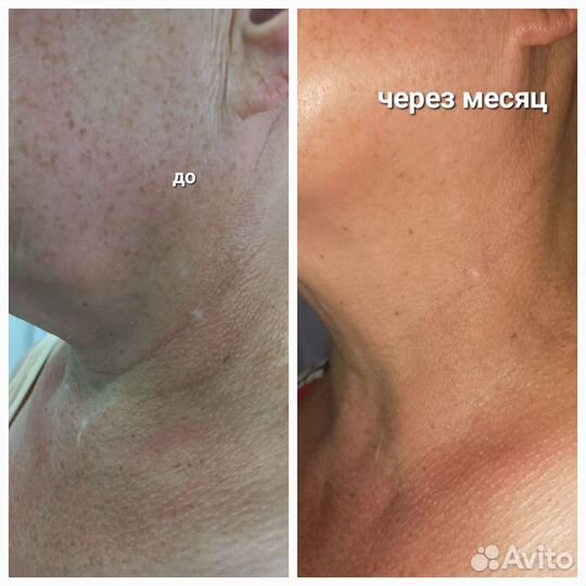 Омоложение лица